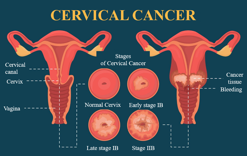 ทำความรู้จักกับมะเร็งปากมดลูก (Cervical cancer)