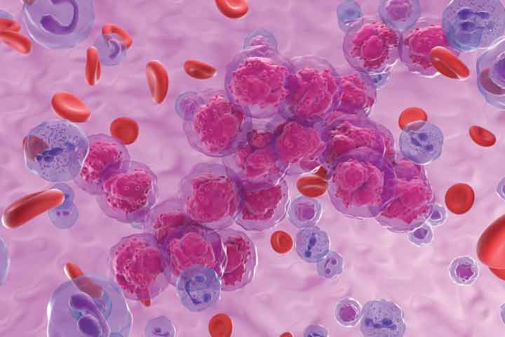 มะเร็งเม็ดเลือดขาวชนิด T-cell Leukemia (Jurkat)