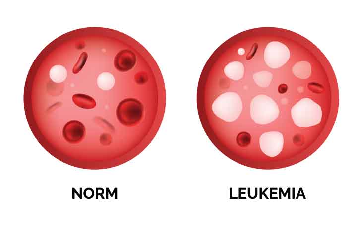 ทำความรู้จักกับมะเร็งเม็ดเลือดขาว (Leukemia)