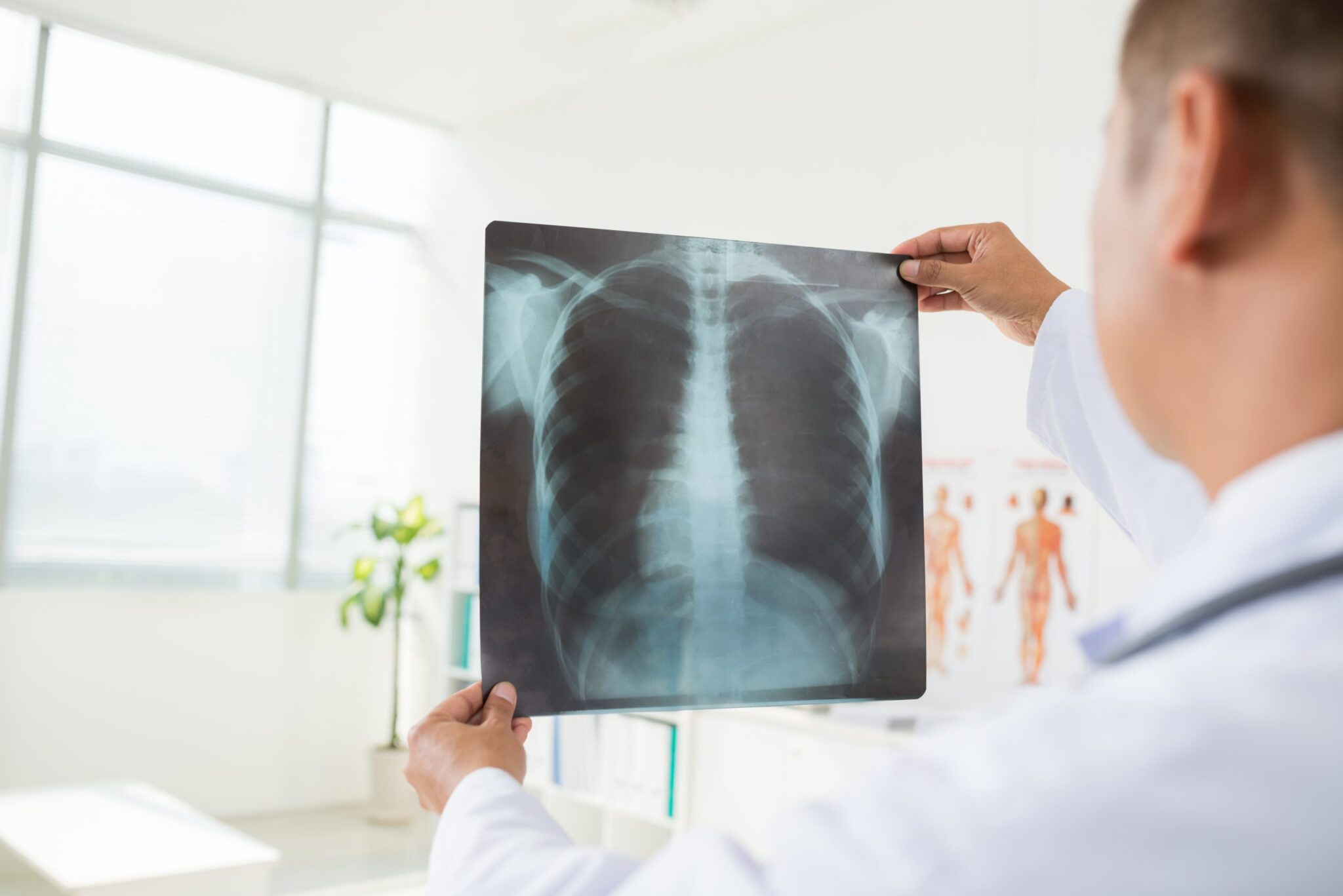 ทำความรู้จักกับมะเร็งปอด (Lung cancer)