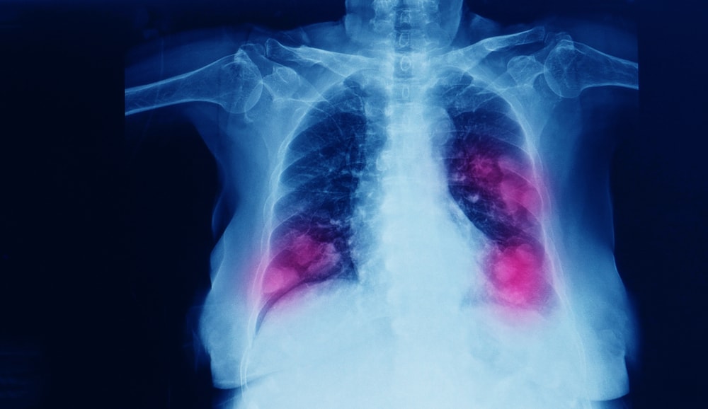 มะเร็งปอดชนิด Adenocarcinoma; Non-small cell lung cancer ปอด แบบ double mutant (NCI-H1975)