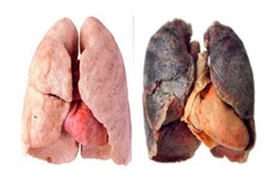 ท ำความรู้จักกับมะเร็งปอด (Lung cancer)