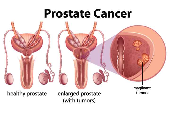 มะเร็งต่อมลูกหมากชนิด Prostate cancer cells line (PC-3)