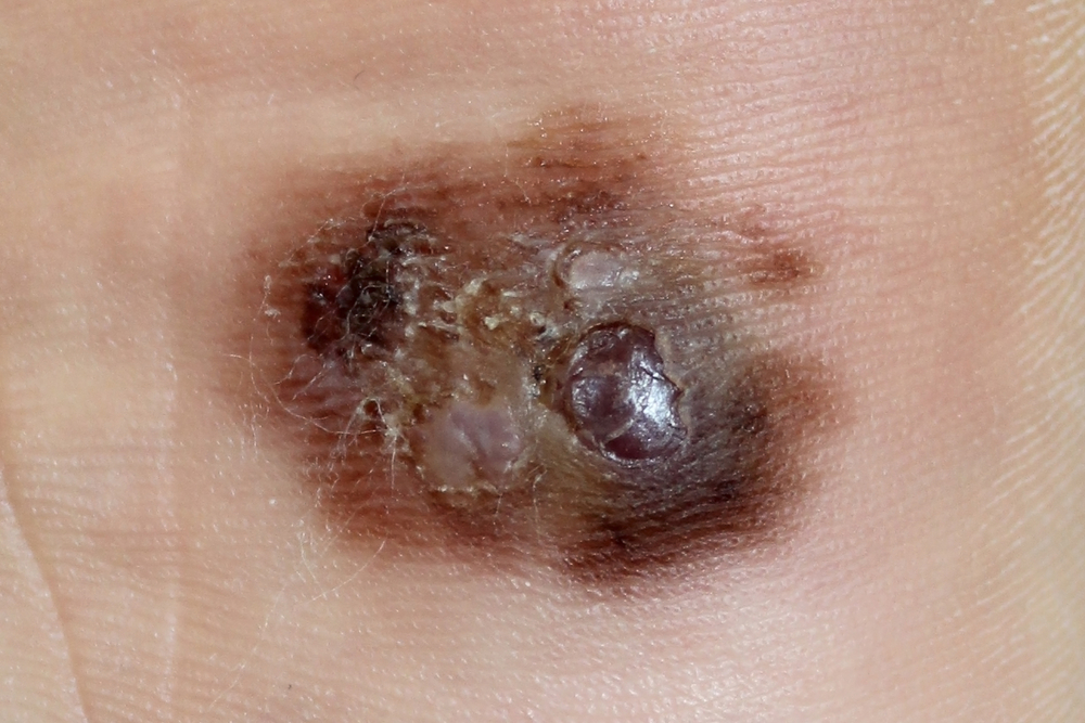 มะเร็งผิวหนังชนิด Human epidermoid carcinoma (A431)