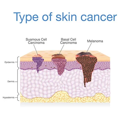 Types of skin cancer