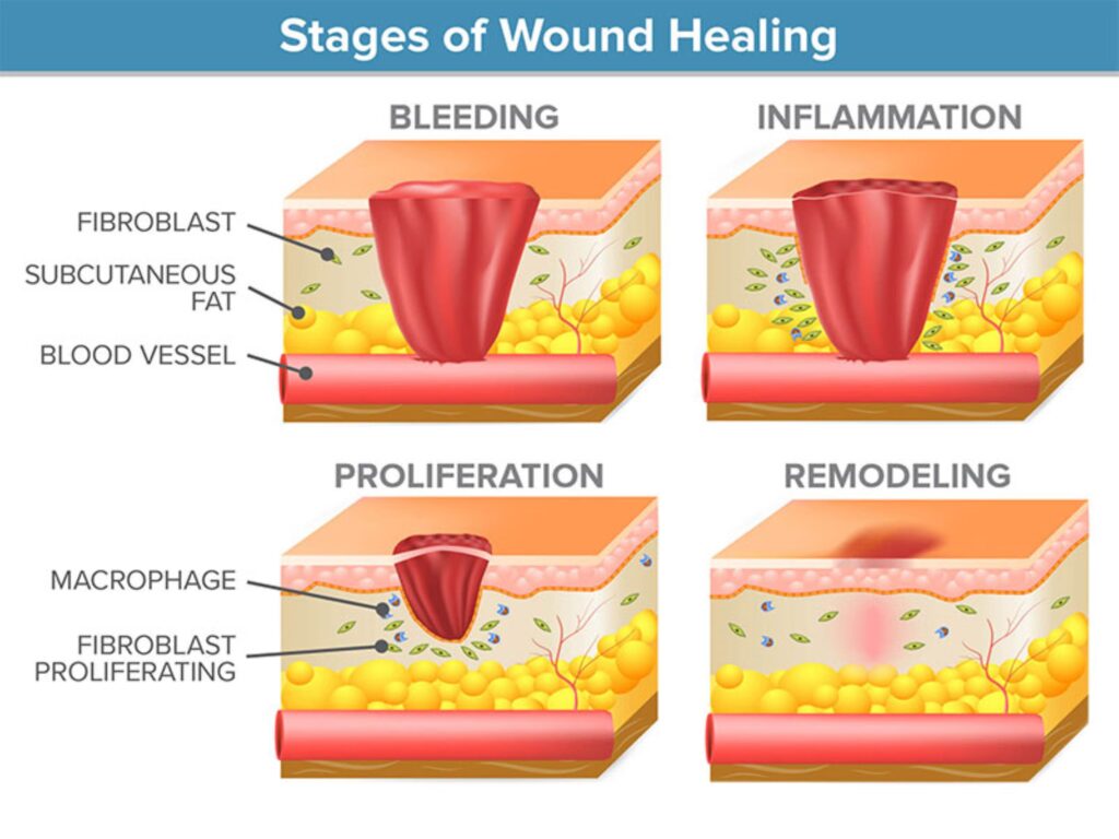 กระบวนการหายของบาดแผล (Wound Healing Process)