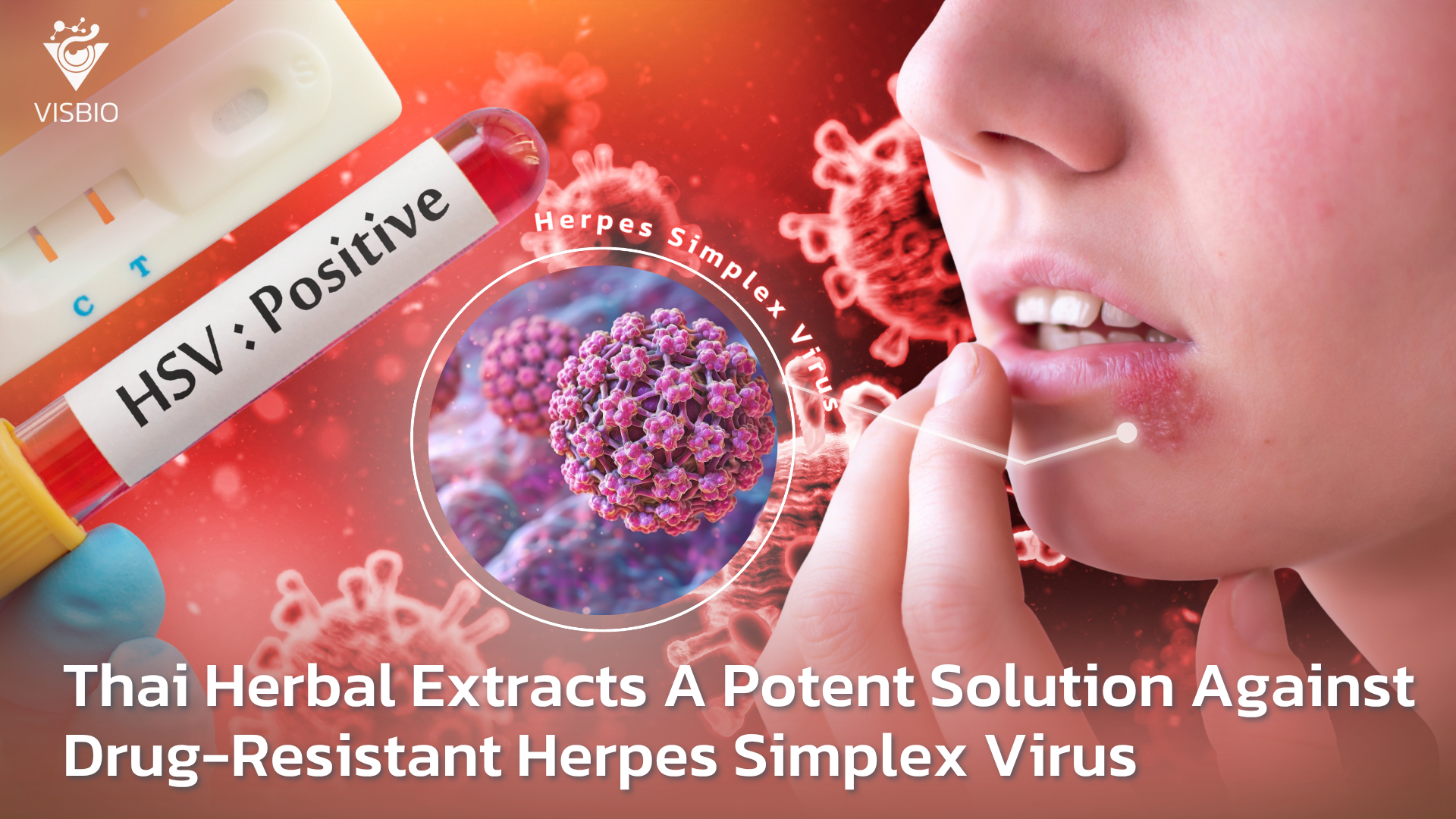 Thai Herbal Extracts A Potent Solution Against Drug-Resistant Herpes Simplex Virus